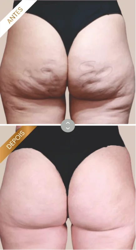 Antes e Depois GoldIncision 1